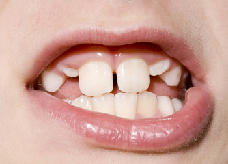 Young Boy's Teeth Closeup