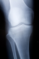 knee x-ray photo for background
