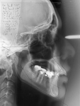 Radiographie dentaire