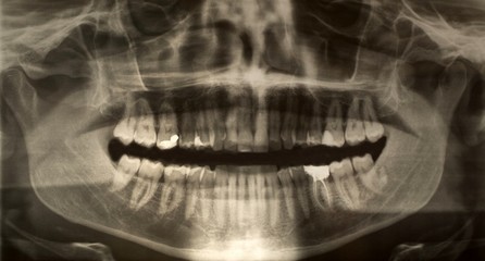 Dental x-ray