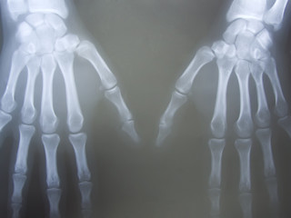 radiograph of human hand