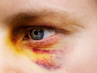 Fototapeta premium Black eye detail of a woman - purple yellow and black
