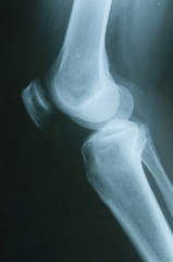 Radiografia del ginocchio