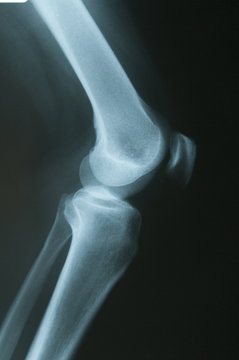 Radiografia del ginocchio