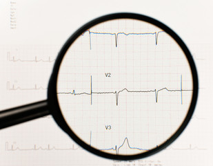 EKG, Or Electrocardiogram, With Magnifying Glass