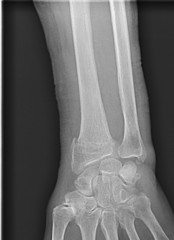 Radiographie fracture du radius