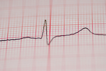 ecg