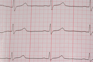 ecg