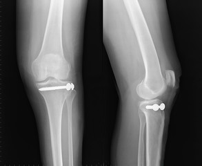Radiographie fracture du genou