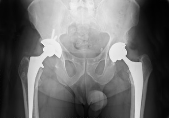 Radiographie Prothèse totale de hanche 