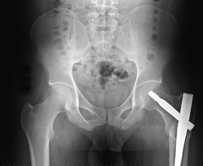 Radiographie Prothèse totale de hanche