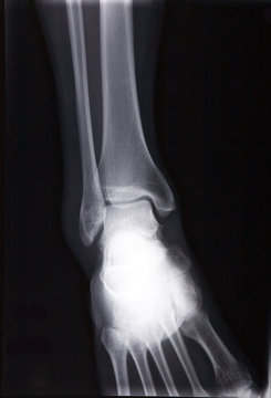 human ankle xray
