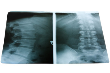 X-Ray Photo