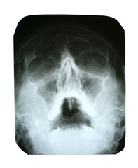 X-ray of Human Head