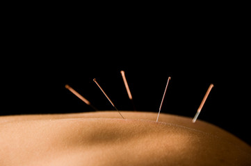 Acupuncture