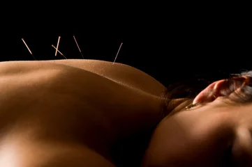 Life Chiropractic and Acupuncture - Acupuncture