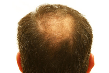 balding head