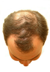 male head with hair loss symptoms