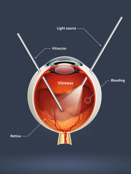 Vitrectomy (eye surgery)