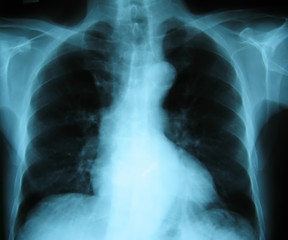 Chest X-ray