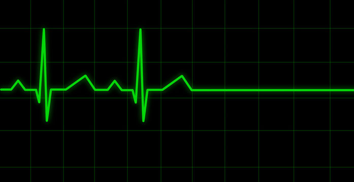 &eacute;lectrocardiogramme