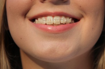 brace