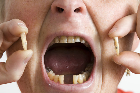 Gebiss mit Zahnausfall Schneidezahn Detail quer