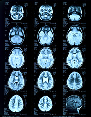 children's head Magnetic risonance image MRI