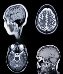 High Resolution  MRI/ MRA (Magnetic Resonance