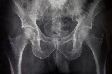 Pelvic x-ray