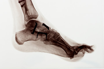 radiography of a foot