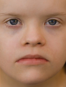 visage d'une enfant trisomique