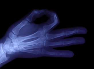 radiography of hand