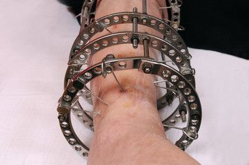 External ring fixator technique in orthopedic medicine