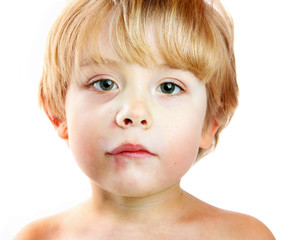 An injured boy with a swollen lip and cheek