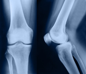 X-ray picture showing knee joints with arthrosis