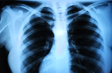 human body's radiograph