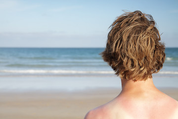 Sunburnt surfer.