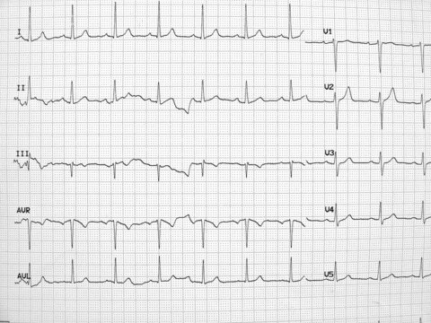 Electrocardiogram-Medical background.