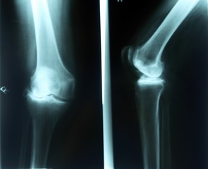 Knie, Röntgenbilder