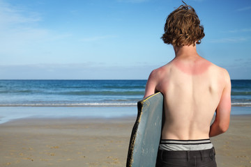 The sunburnt surfer.