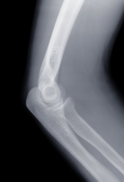 X-ray of a human knee