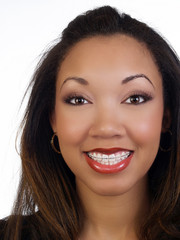 Young black woman with big smile braces upper teeth