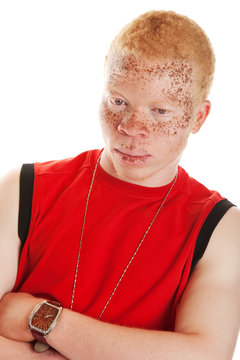 Albino Man
