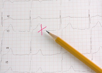 pencil and cardiogram