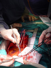 a surgical intervention