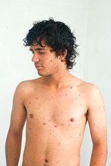 chicken pox