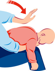 Adult performing Heimlich maneuver on infant