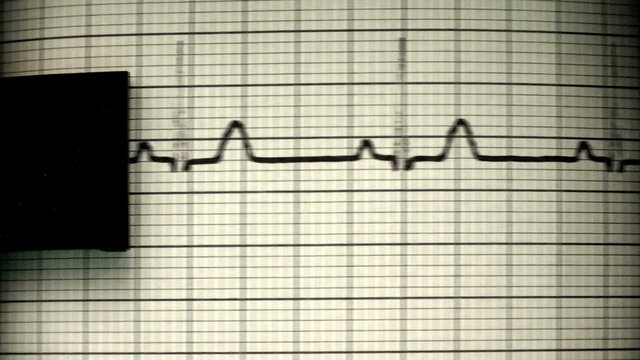 EKG defibrillator printer close-up - HD