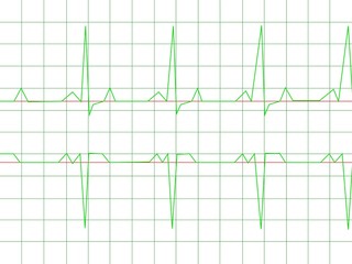Normal Heart Rhythm